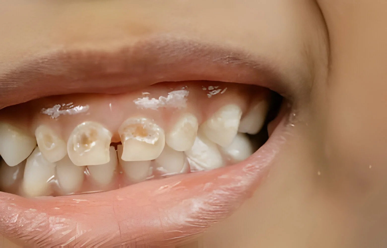 Dental Decay / Cavities Management